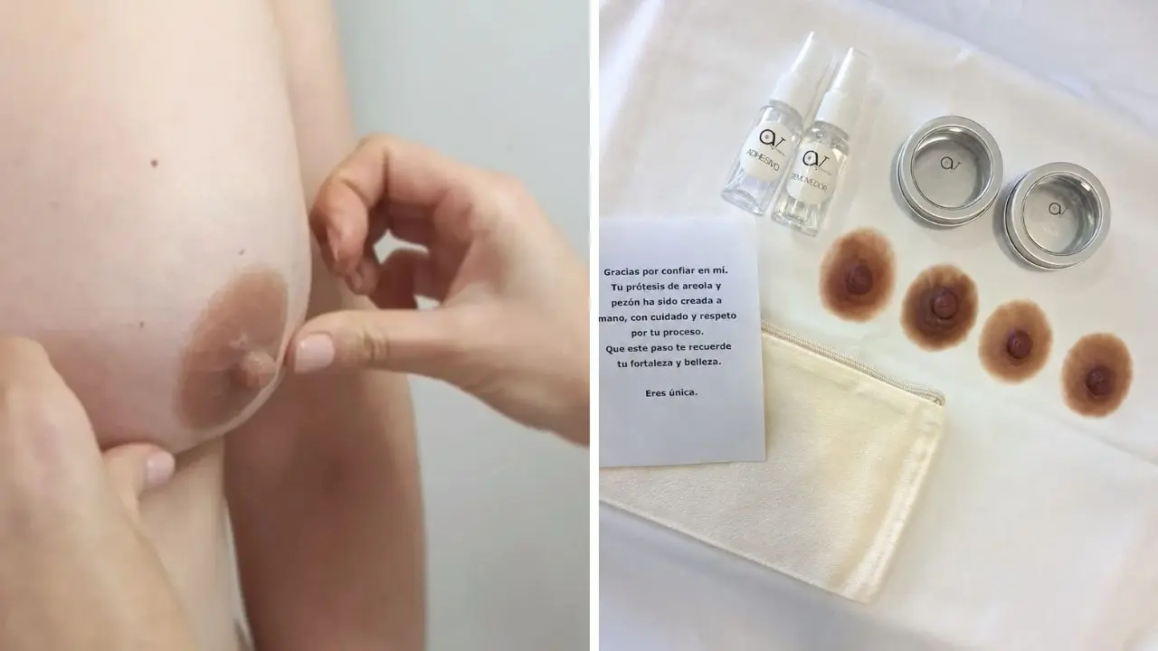 Vista de una reconstrucción de areola y pezón con prótesis de silicona
